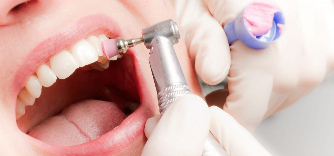 Професійна чистка зубів ― робити чи утриматися?